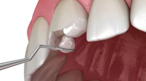 Composite Resin Veneers