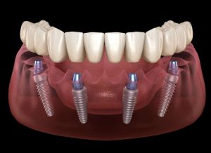 Dental Implants Near Me