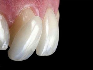 Porcelain Veneers Dentist