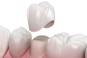 Price for Dental Crowns