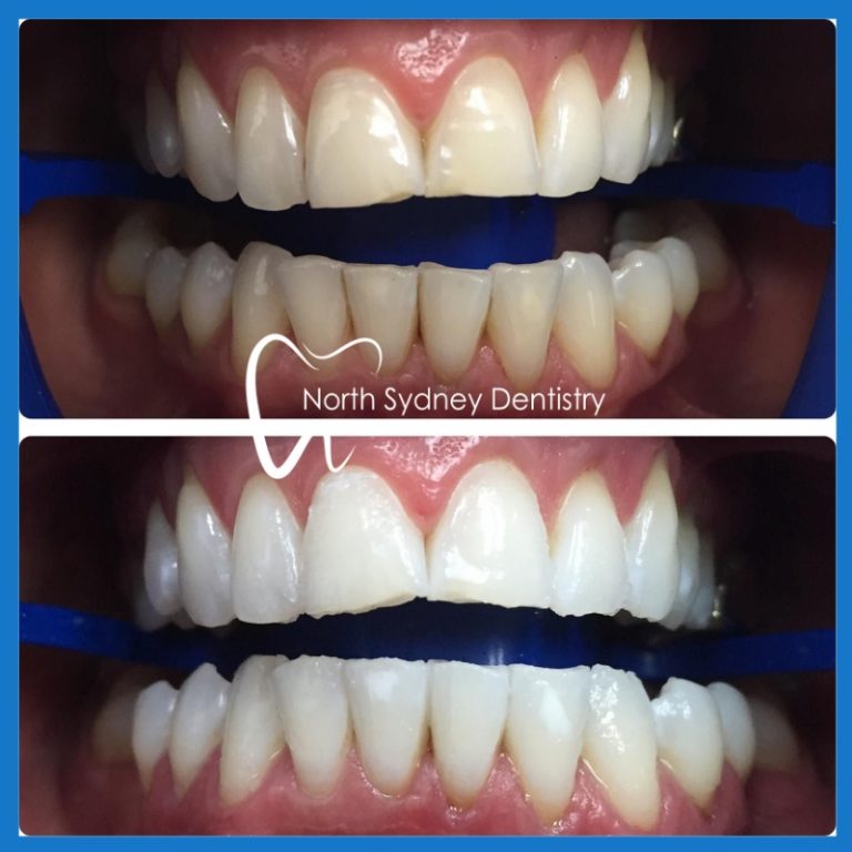 Teeth Whitening Package North Sydney Dentistry