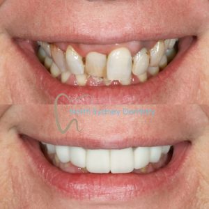 Dental Veneers Before and After