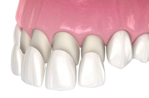 Teeth Veneers